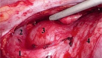 Конечный вид операционного поля. Видны свободные от клетчатки верхняя полая (1) и левая плечеголовная вены (2), дуга аорты (3), перикард (4)